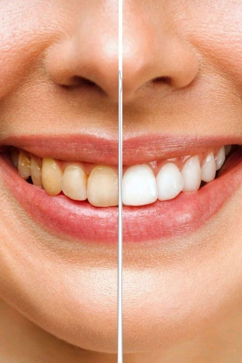 Professional Teeth Whitening Treatment Mysore